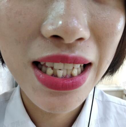 黔东南州人民医院口腔科牙齿矫正前