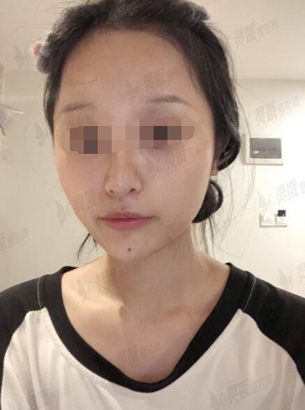 粤北人民医院整形美容科祛疤后3个月