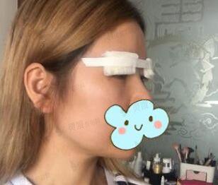 陈海华修复双眼皮手术过程