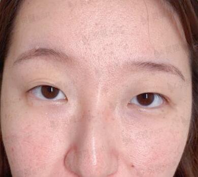四川省人民医院刘全双眼皮案例反馈，短短3个月就让我拥有“如花美眼”