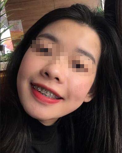 北京赛德阳光口腔门诊部牙齿矫正案例