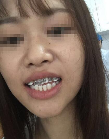 北京赛德阳光口腔门诊部地包天牙齿矫正案例
