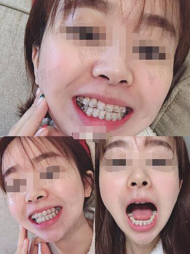 北京拜尔昊城口腔医院牙齿矫正案例