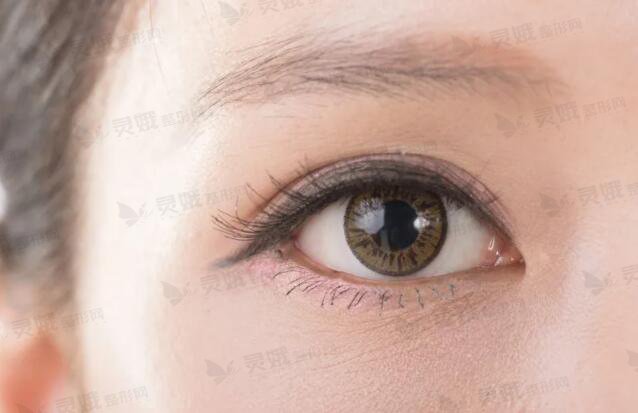 微创双眼皮是长期的吗