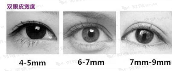 正常双眼皮宽度：6mm~8.5mm