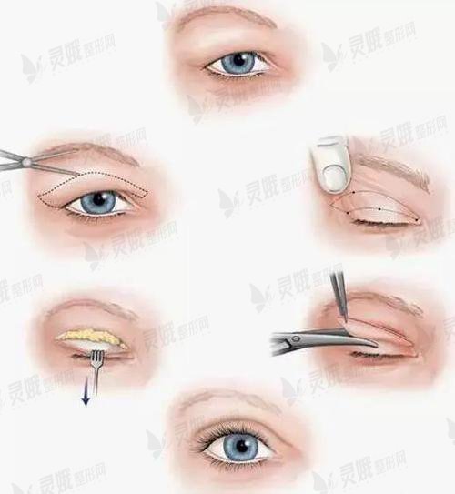 双眼皮修复手术的方法有什么?