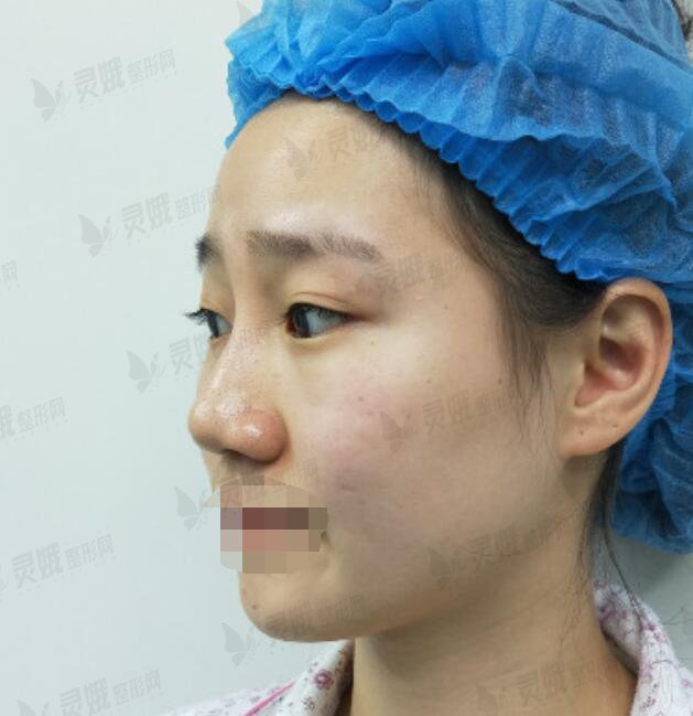 重庆西南医院隆鼻手术后一周