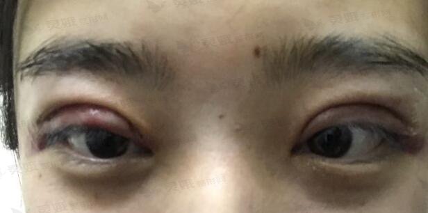 西安唯星颜医疗美容双眼皮手术后一周