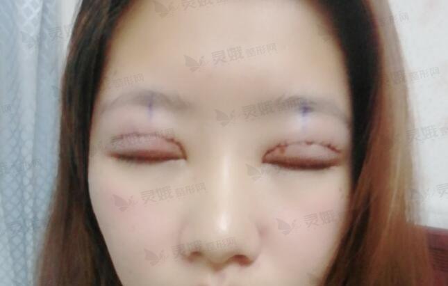甘肃省人民医院整形外科双眼皮后7天