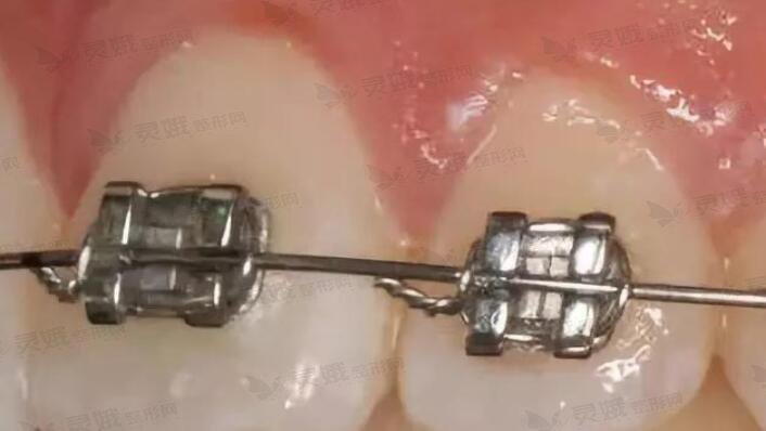 牙齿矫正的过程步骤