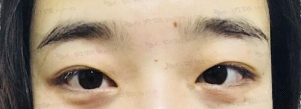 青海省交通医院整形美容科割双眼皮手术前