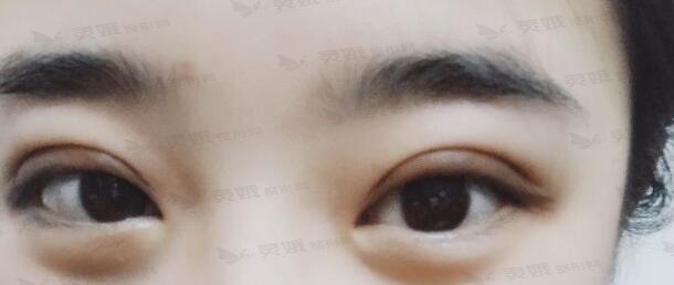 青海省交通医院整形美容科割双眼皮手术后47天