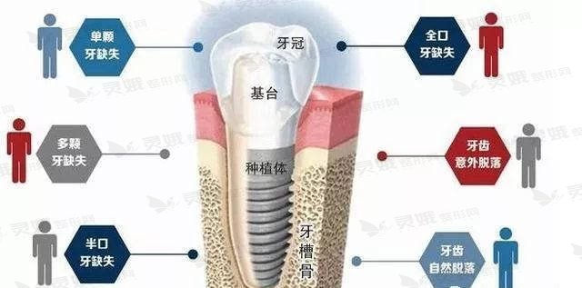 薛卫东医生擅长项目科普——牙齿种植