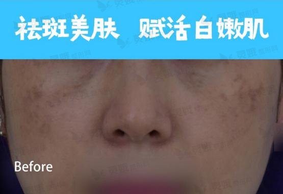 杭州师范大学附属医院整形美容科像素激光祛斑图