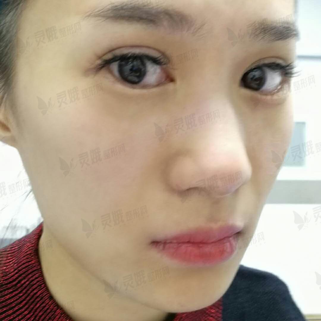 陕西省人民医院整形美容科去眼袋案例：术后15天