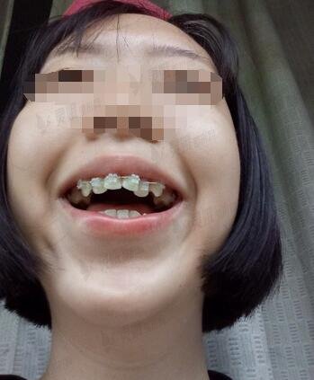 咸阳市中心医院牙科牙齿矫正手术案例