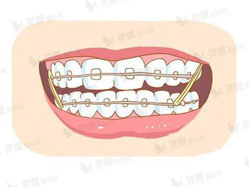 牙齿矫正的操作方式是什么?