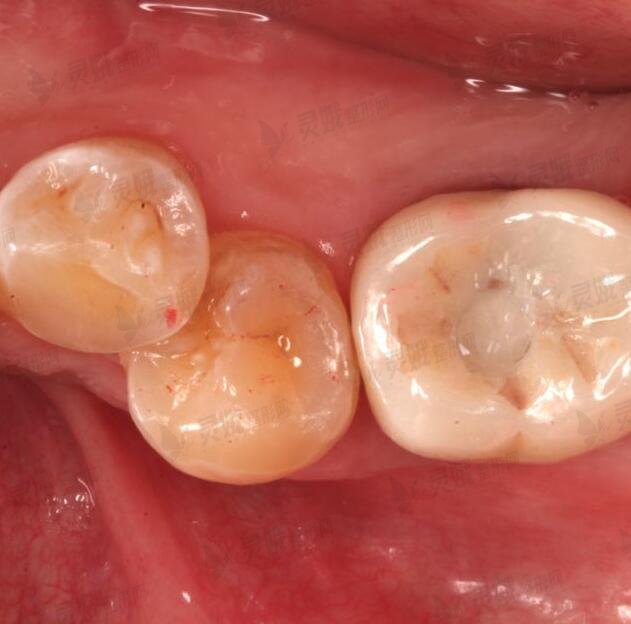 麦芽口腔医院牙齿种植后