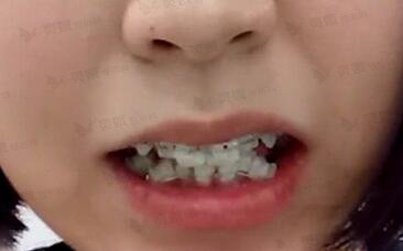 西安交大附属二院口腔科牙齿矫正手术案例：