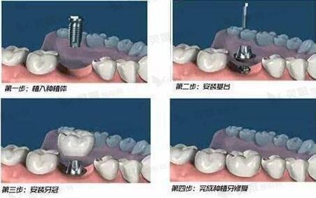 种植牙的操作过程是什么