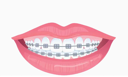 牙齿矫正大概要花费多少钱？都有哪些影响因素？