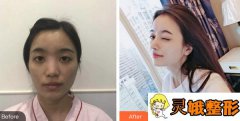 杭州静港医疗美容诊所程卫民整形价格表附鼻部手术案例展示
