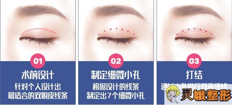 韩式定点双眼皮手术能维持几年