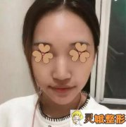 想知道深圳美莱梁晓健医生做鼻子多少钱吗？我用真实案例告诉你！