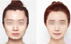 韩国做面部轮廓整形哪个医生好？女神推荐+真人案例