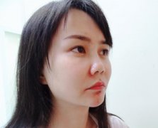 在北京地区做假体隆鼻记录贴~戳进来看实例