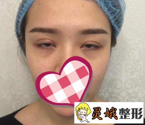 成都刘辅蓉双眼皮修复案例，让眼睛变得更美！附较新价格表
