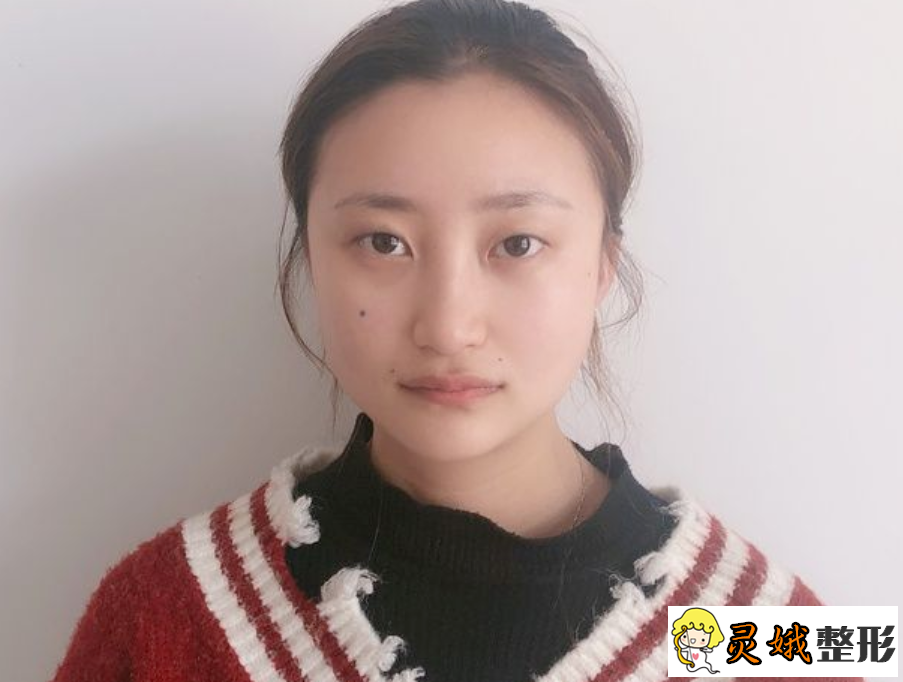 北京做双眼皮多少钱，双眼皮失败的修复方法有哪些？