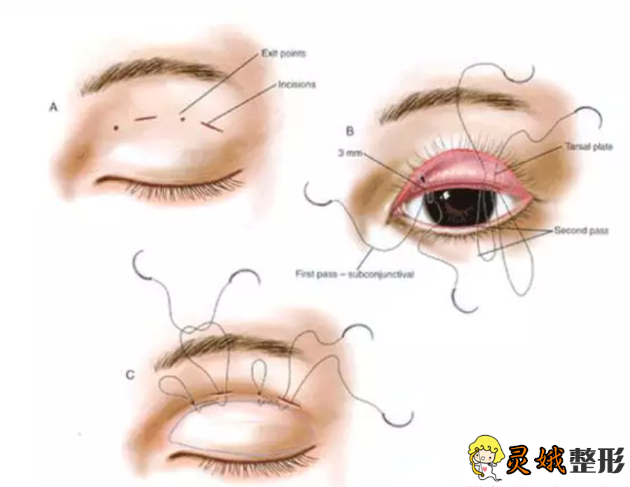 高分子压双眼皮手术的原理、适用范围及常见问题全解析