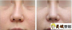 歪鼻形成原因是什么？鼻梁歪斜临床矫正方法公开