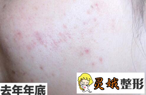 北京伊美尔医院激光祛痘印后1个月
