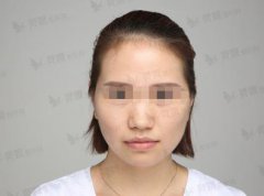 北京韩式隆鼻：较新隆鼻案例分享：精致美鼻带来的巨大变化！