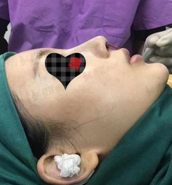 硅胶 耳软骨隆鼻手术过程