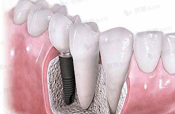 种植牙的稳定性和没问题性如何