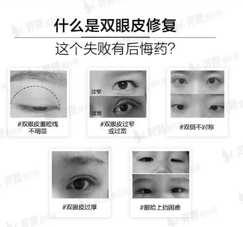 双眼皮失败的八种图片：对比一下你的双眼皮是否做成功了？