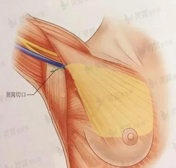 乳房下垂分为几类