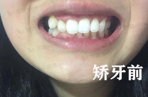湖南省第二人民医院口腔科牙齿矫正前