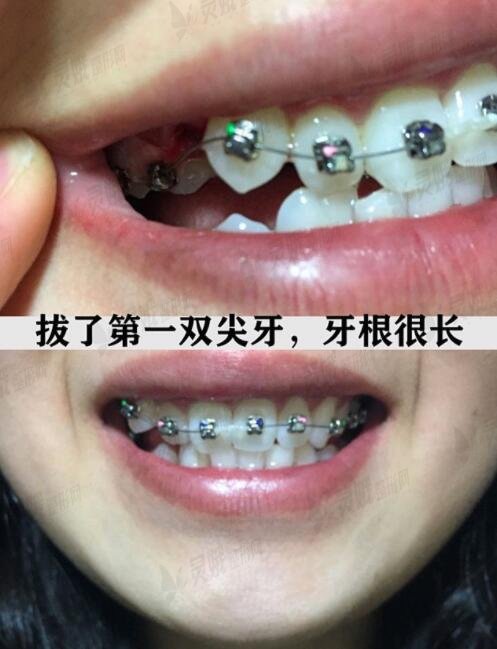 湖南省第二人民医院口腔科牙齿矫正中
