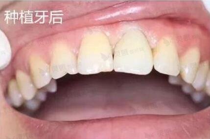 北京维乐口腔种植牙后