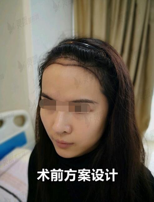 中国医学科学院整形医院毛发移植前