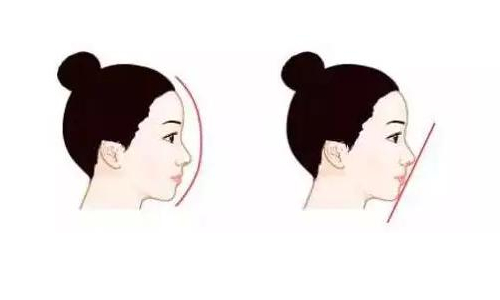 上海九院刘凯隆鼻手术好嘛？做鼻子怎么样？肋软骨隆鼻术后果图！
