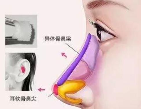 鼻部手术1.jpg